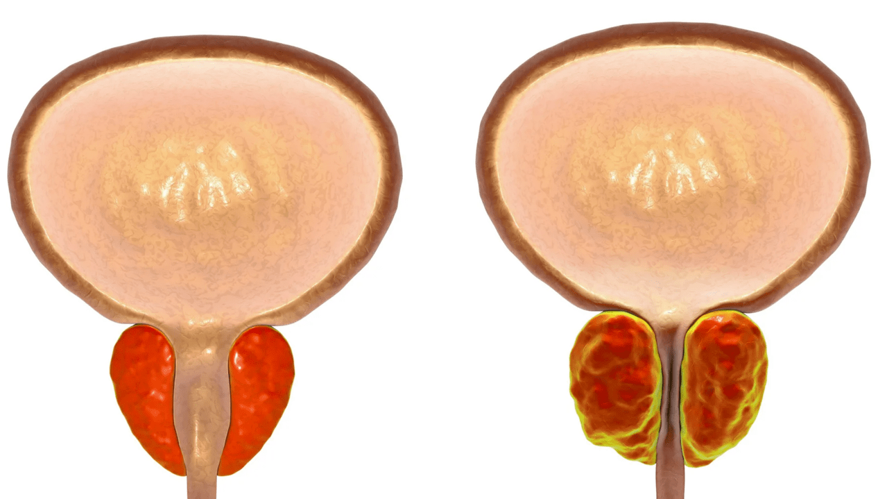 Cos'è la prostatite