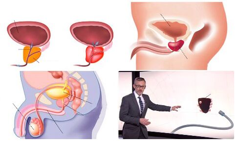 prostata sana e malata